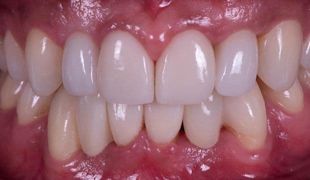Full mouth reconstruction – orthodontics, implants, veneers and adhesive bridges