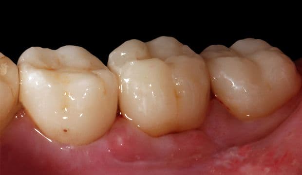 Result oft the single-tooth immediate implant at Dental Clinic London