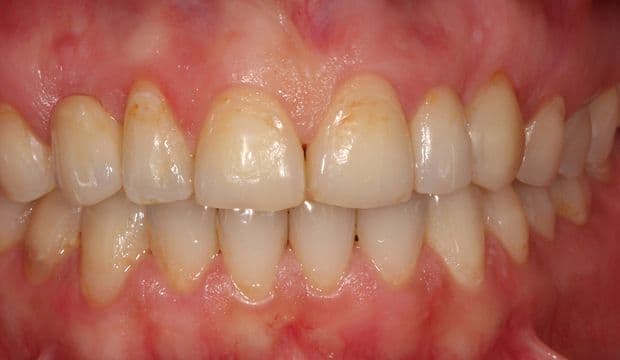 Result of replacing missing front teeth with Maryland bridges