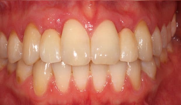 Replacing missing front teeth with Maryland bridges result