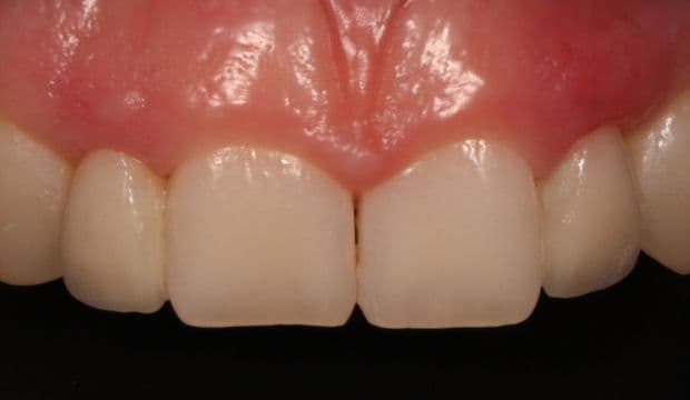 All-ceramic adhesive bridges (Maryland bridges) in the upper jaw after treatment - Dental Clinic Wimpolestreet