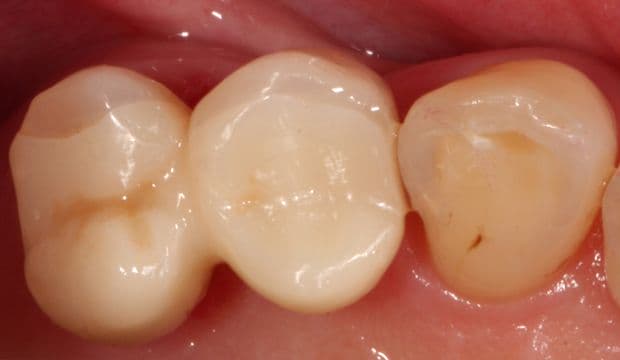 Replacing missing teeths with a Maryland bridge - Dental Clinic London