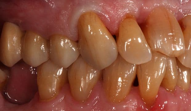 All-ceramic conventional bridge closes the row of teeth - dental office in Wimpolestreet