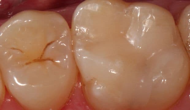 Fillings on posterior teeth result of treatment - german dentist at Wimpolestreet