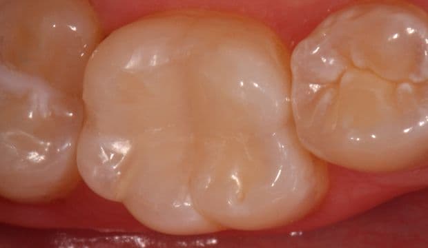 Removing decay/caries on posterior tooth result of treatment - dentist at Wimpolestreet