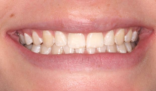 Invisalign/Orthodontics treatment of front teeth with gaps in between them result - Dental Clinic London