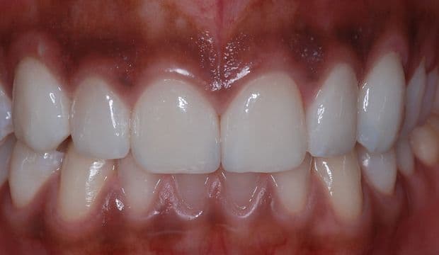 Aesthetic treatment with veneers after - Dental Clinic London