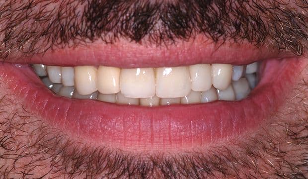 Restoration of the entire dentition result - german dentist Wimpolestreet