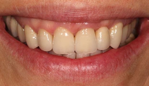 Restoration of the entire dentition result at Dental Clinic London
