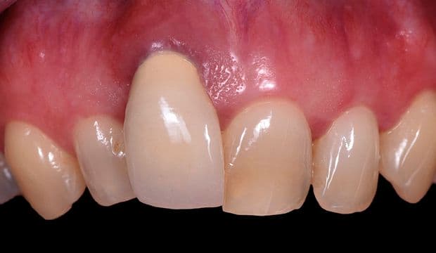 Orthodontics and single-tooth implant at Dental Clinic London