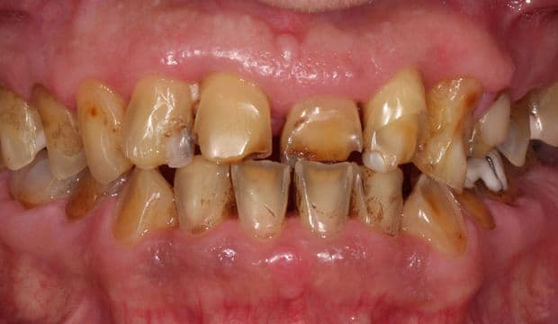 Full mouth reconstruction before