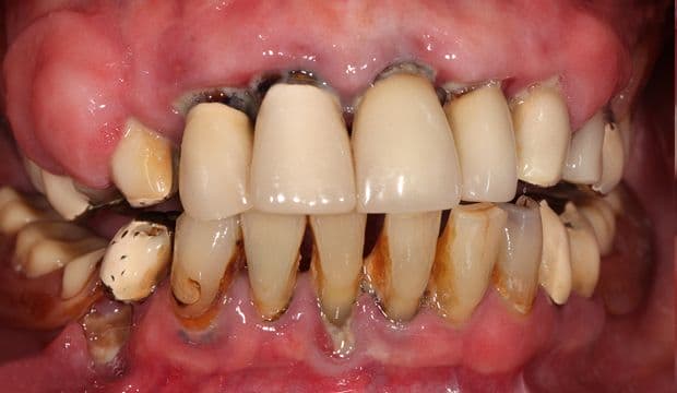 Full mouth reconstruction before treatment - german dentist London