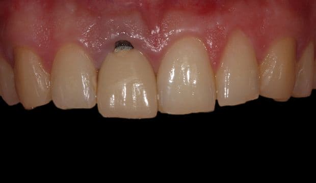 Single implants replacing front teeth at Dental Clinic London