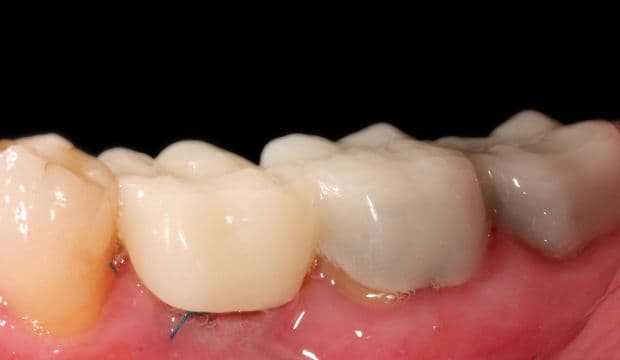Single-tooth immediate implant before treatment - german dentist London
