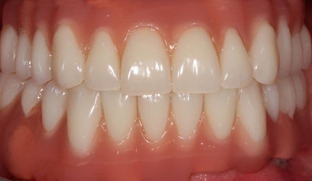 All-on-4 result of treatment - Dentist at Wimpolestreet London