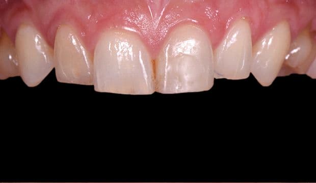 Aesthetic treatment with veneers at german dentist in London