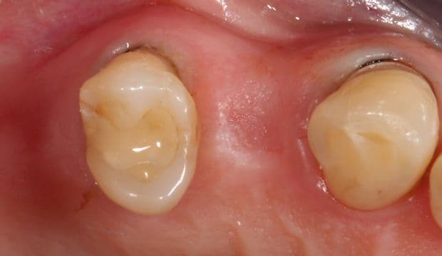 All-ceramic adhesive bridges (Maryland bridges) - Dental Clinic London