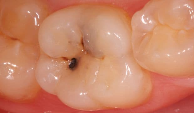 Removing decay/caries on posterior tooth - Dental Clinic