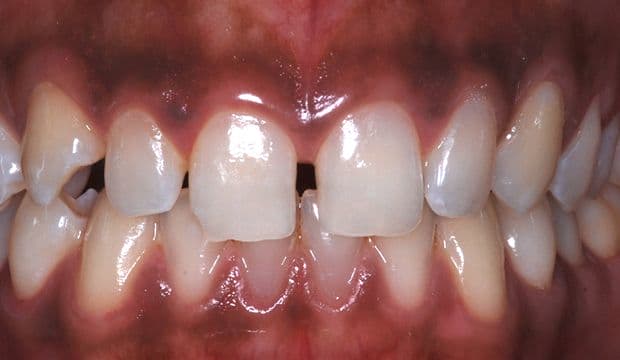 Aesthetic treatment with veneers befor - Dentist at Wimpolestreet London