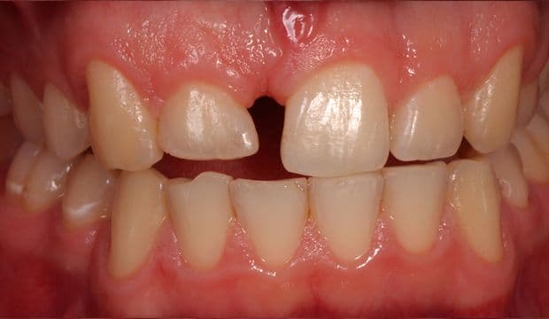 Aesthetic treatment with a single crown needed - Dental Clinic London