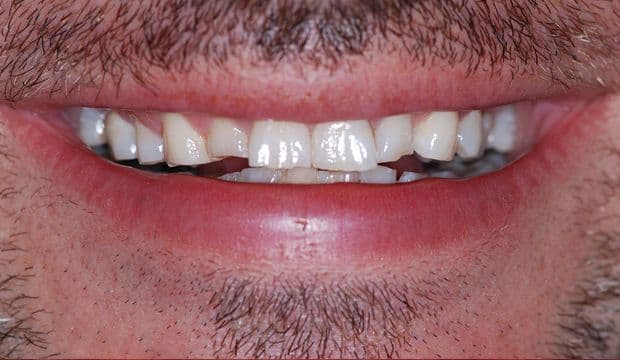 Restoration of the entire dentition needed - german dentist Wimpolestreet