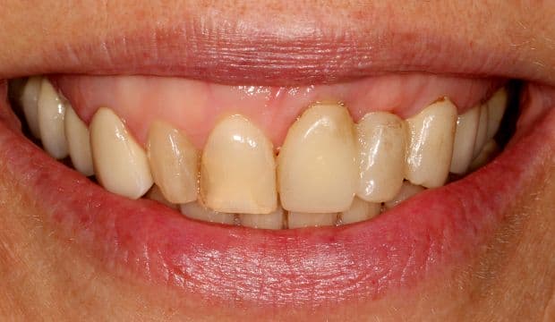 Restoration of the entire dentition at Dental Clinic London