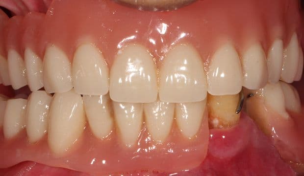 All-on-4 - Implants at Dental Clinic London