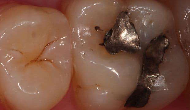 Fillings on posterior teeth - Dental Clinic Wimpolstreet