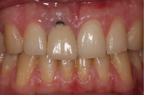 dental crown before after part 1