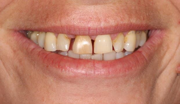 All-on-4 dental implants