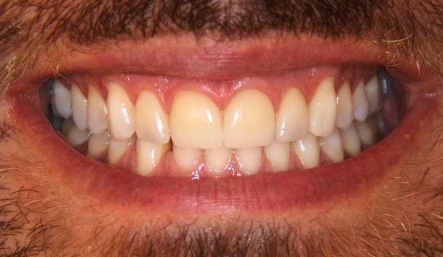 Veneers before and after