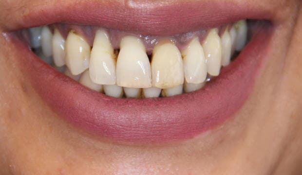 Fillings - before and after