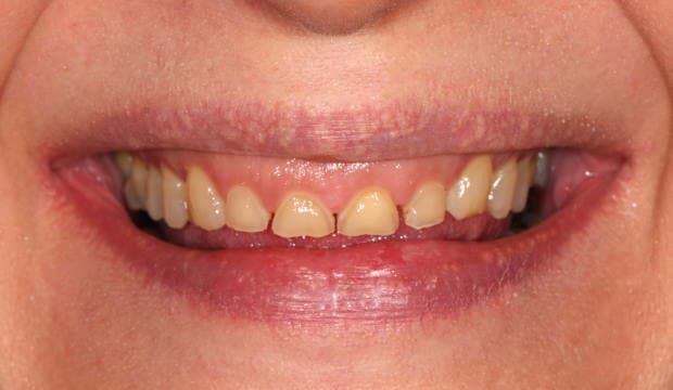 Veneers before and after