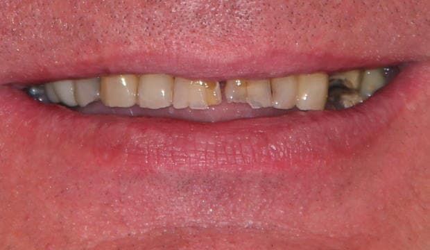 Invisalign before and after