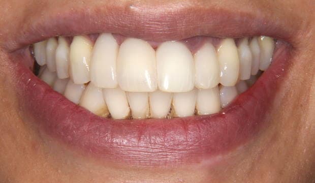 Fillings - before and after