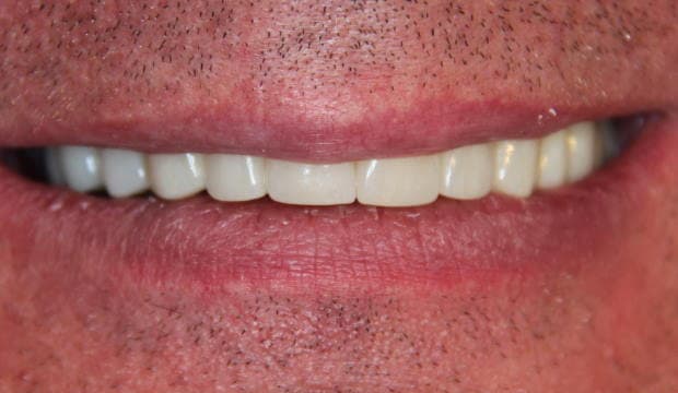Full mouth reconstruction