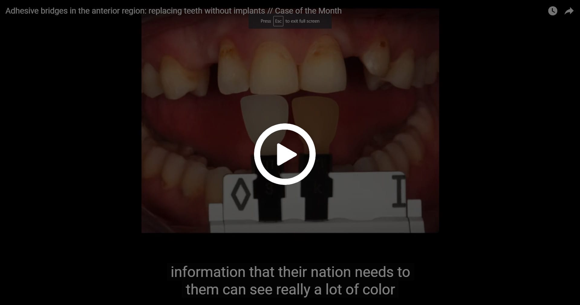 Adhesive bridges in the anterior region replacing teeth without