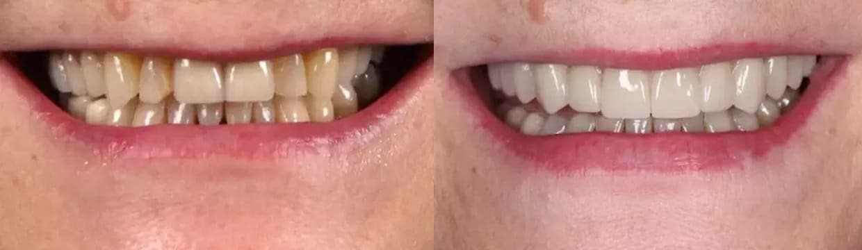 Chipped Teeth repair in London Ontario - London Ontario Dental Clinic