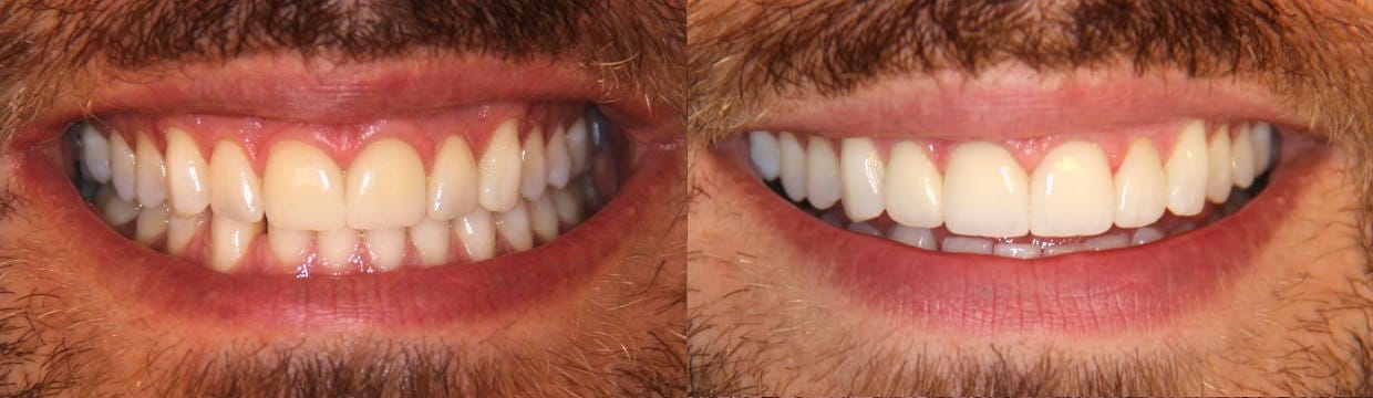 Veneers Upper Jaw – The Importance Of A Good Dental Technician ...